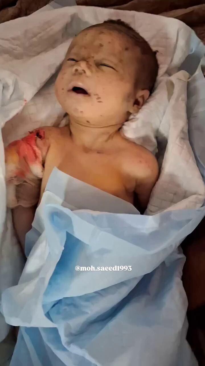 Infant Dies from Injuries in Gaza Israeli Bombing