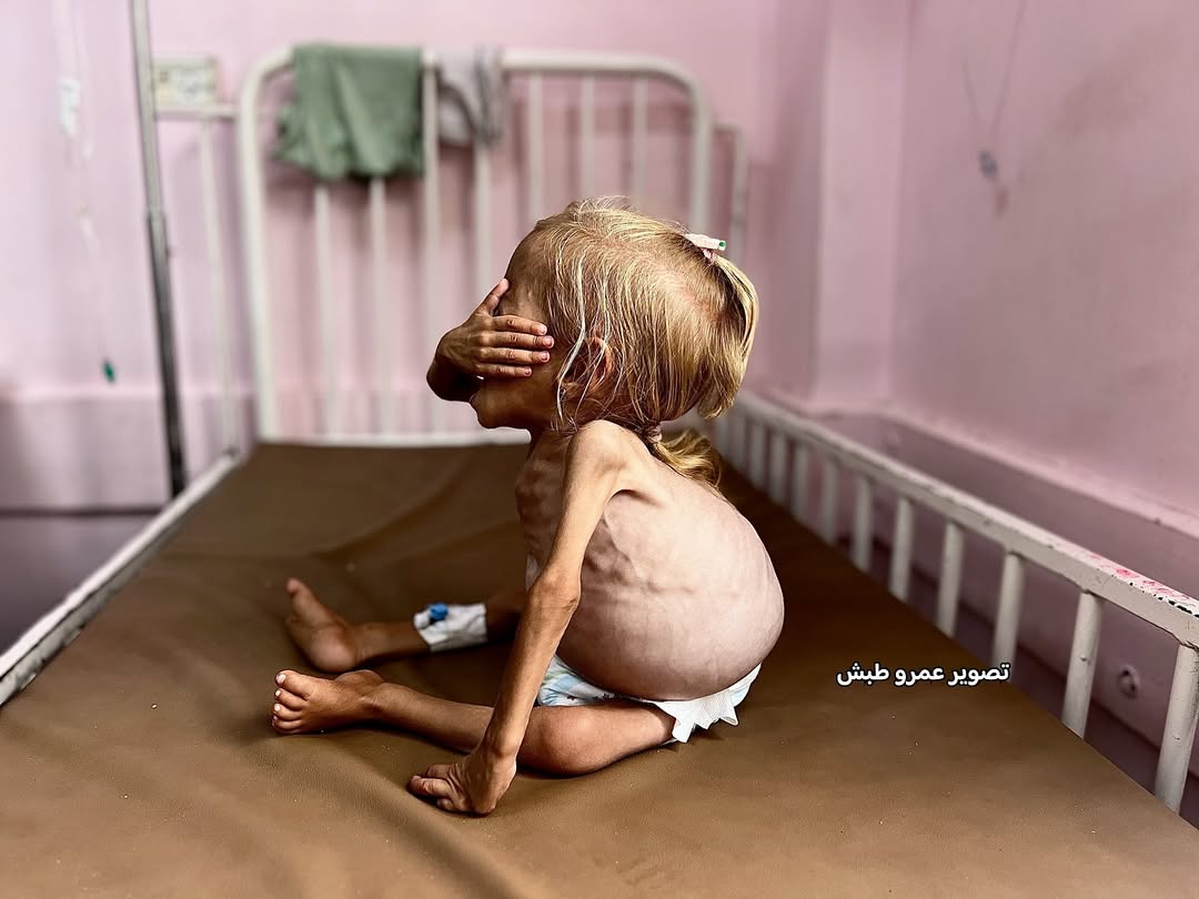 Critical Health Crisis: Severely Malnourished Two-Year-Old Child