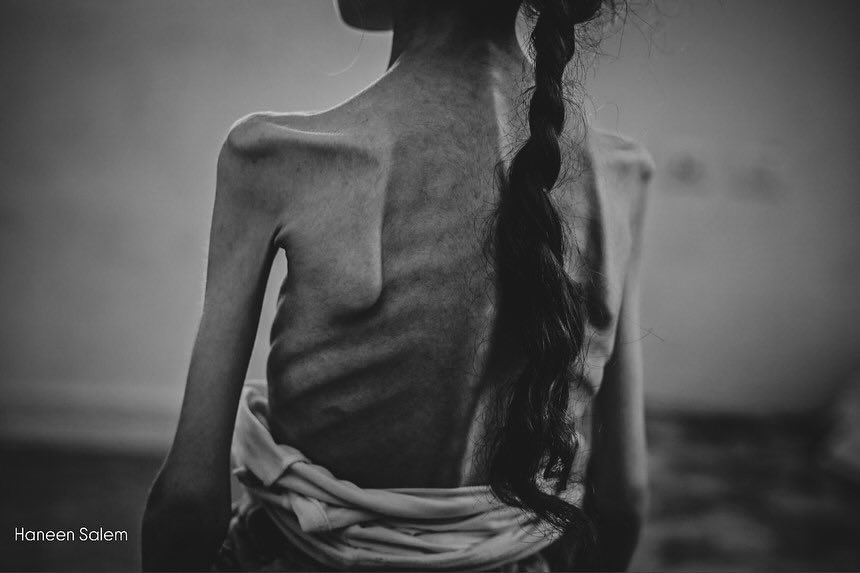 Witkoff Gaza visit fails to hide famine crisis evidence