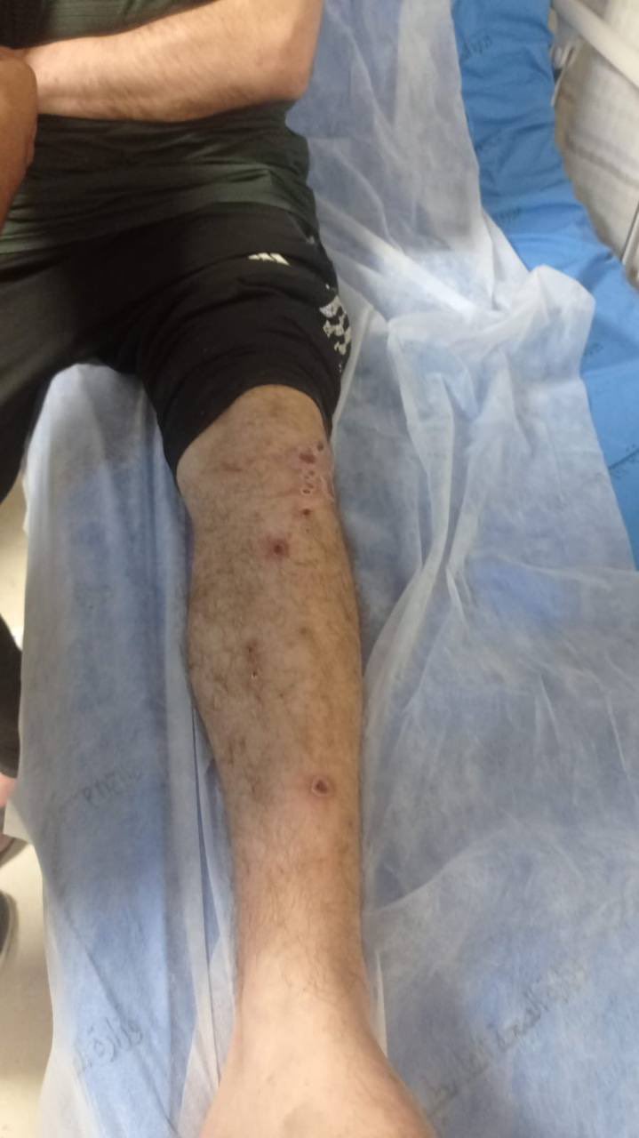 Released Palestinian Prisoner Hamza Al-Saifi Hospitalized After Torture