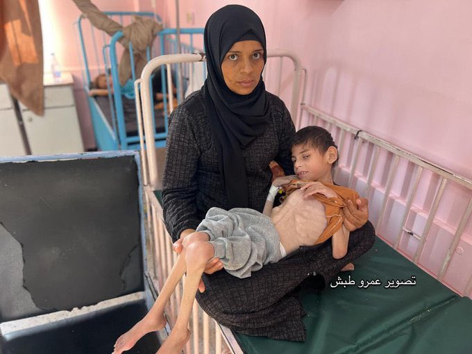 Malnourished and Dehydrated: Israeli Aid Ban in Gaza