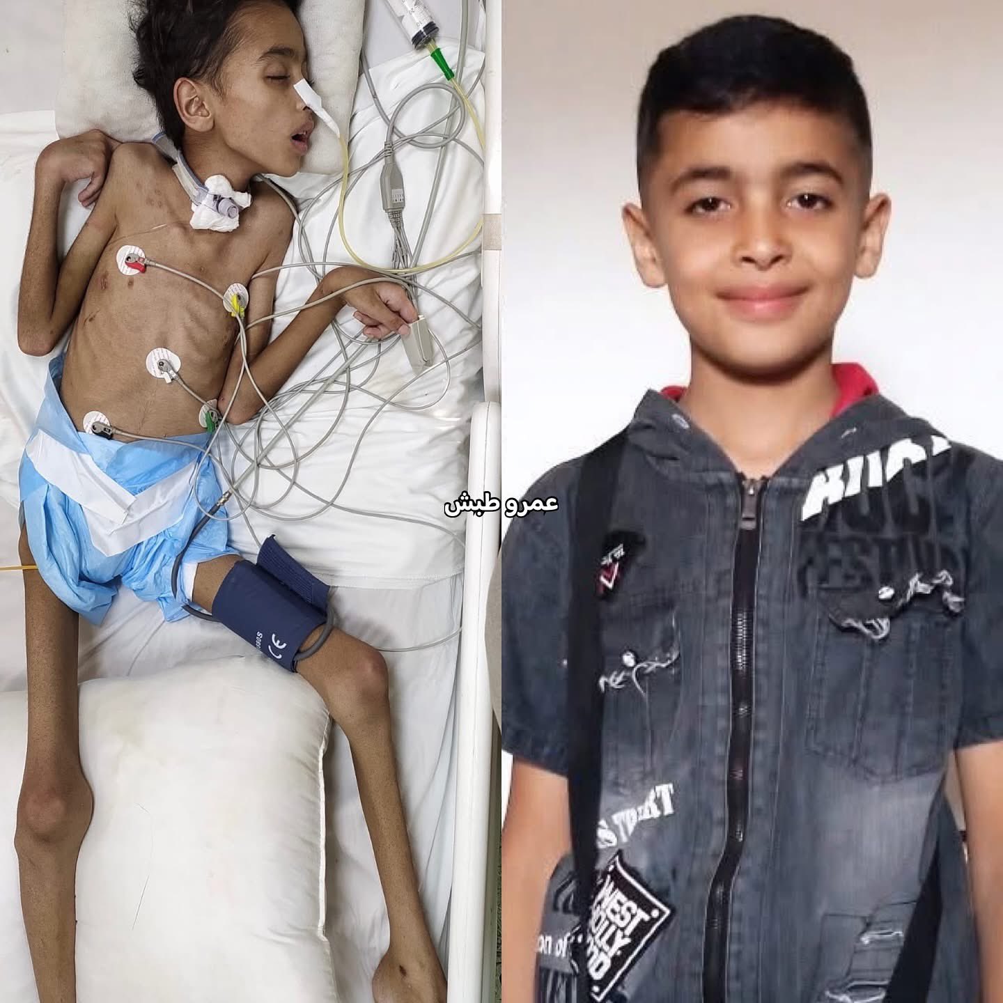 11-Year-Old Child Suffers Critical Injuries from Shrapnel Wounds