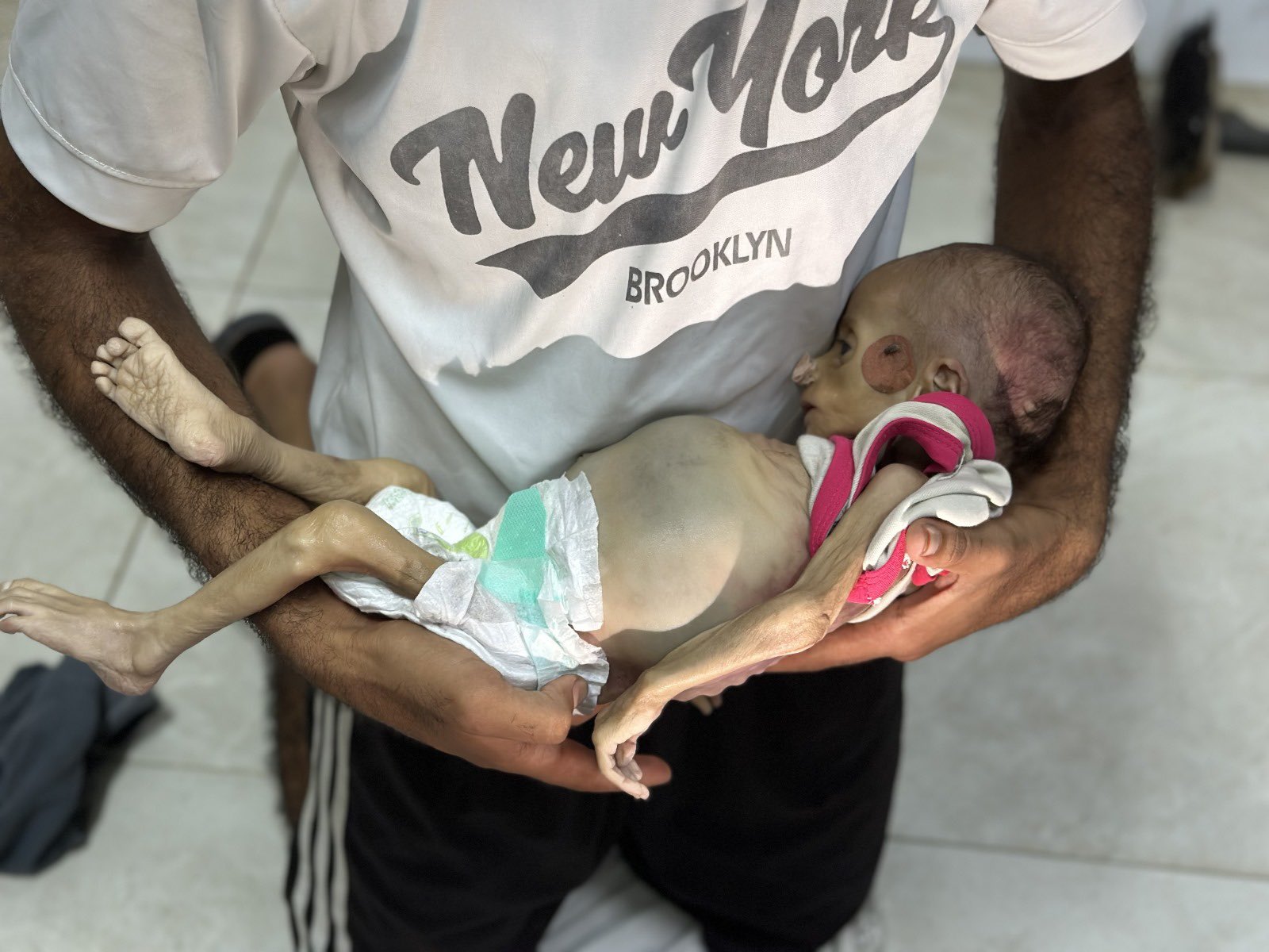 Infant Death from Malnutrition in Gaza Amid Blockade