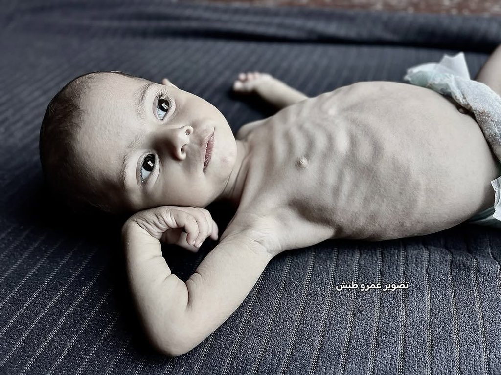 UNICEF Reports Severe Child Malnutrition Crisis in Gaza