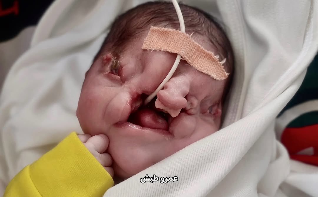 Infant’s Severe Facial Deformities From Maternal War Exposure