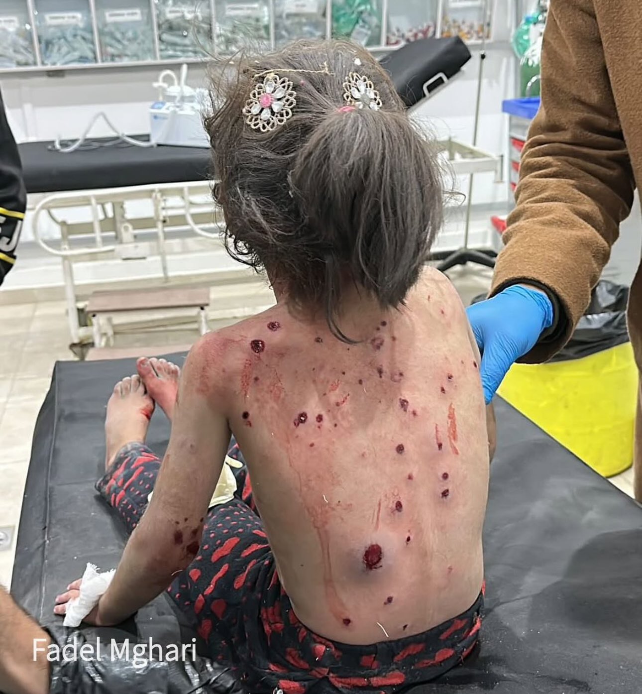 Palestinian Girl Injured in Israeli Artillery Strike Gaza