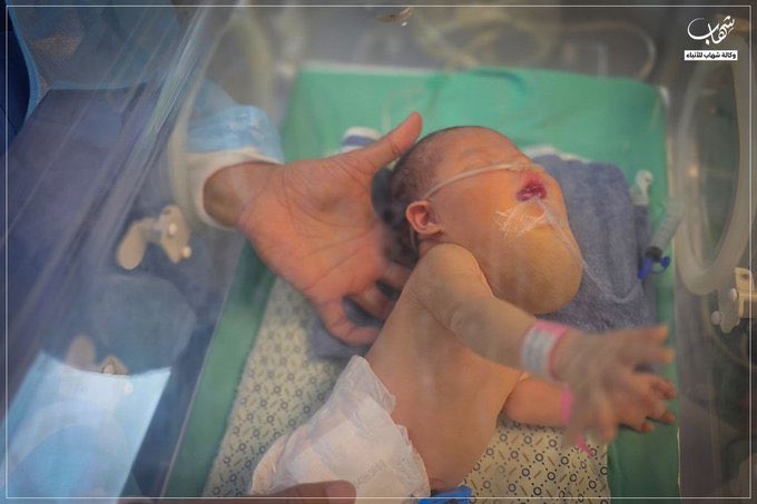 Palestinian baby Dua Qishta needs urgent medical transfer from Gaza