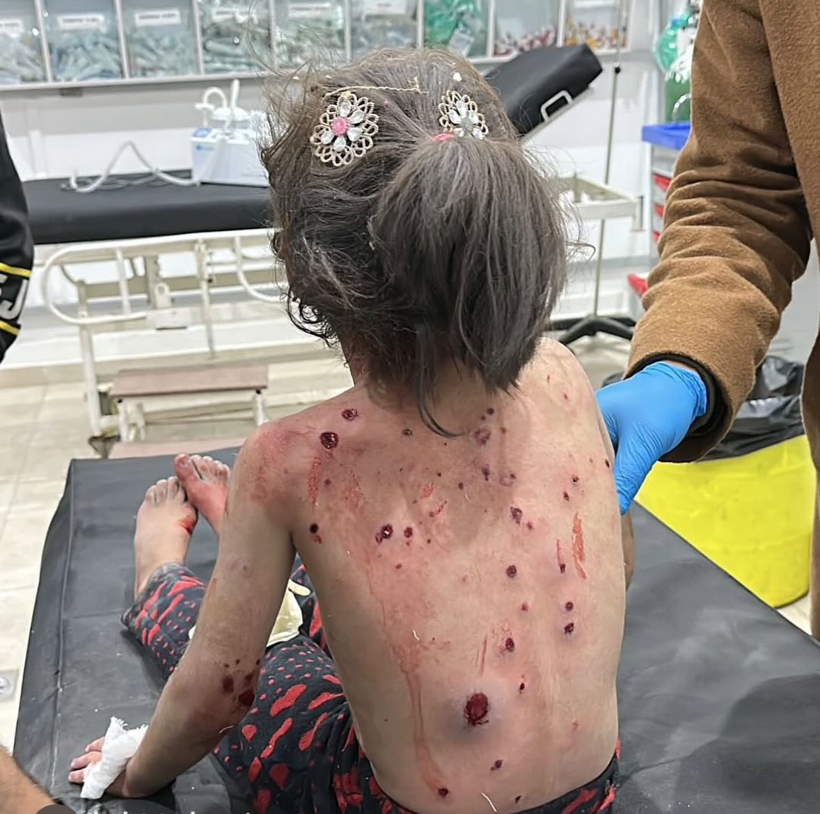 Palestinian Child Injured in Israeli Artillery Attack Gaza
