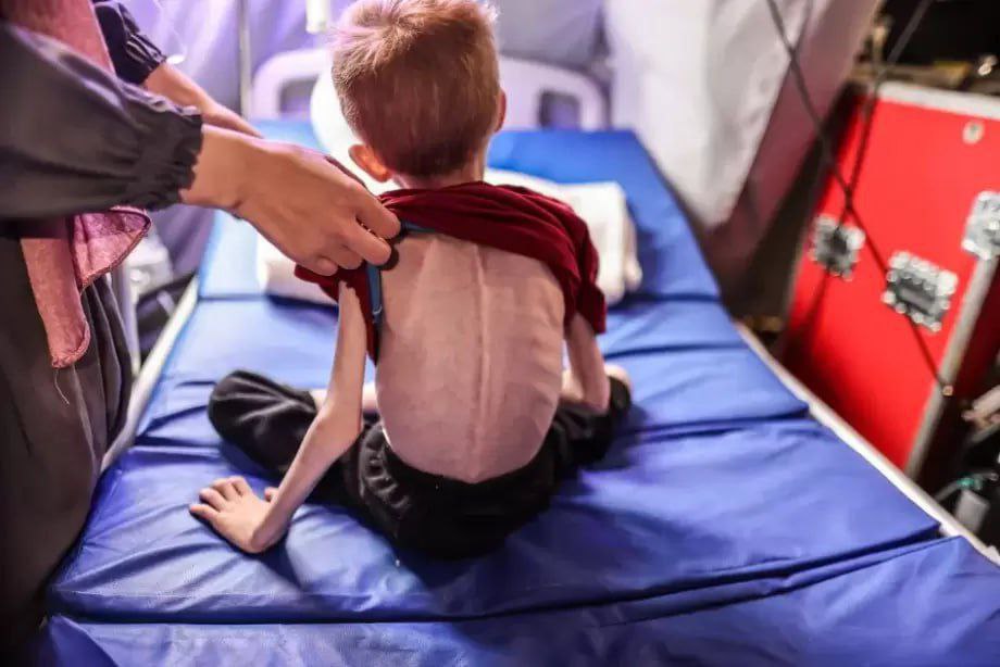 Gaza children face severe hunger risks amid Israeli blockade