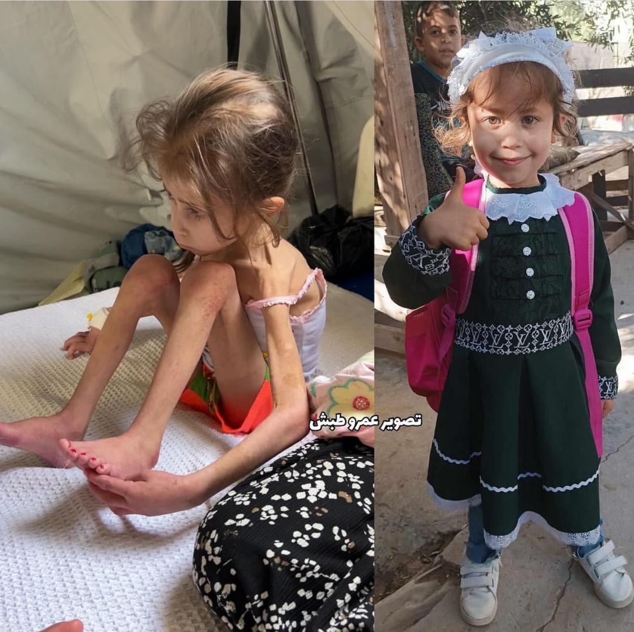 Child malnutrition in Gaza under Israeli blockade