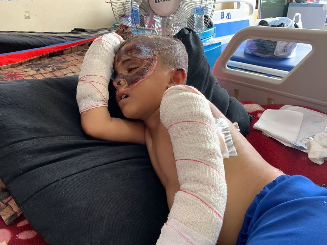 Four-year-old Ahmad fights severe burns after Israeli strike kills parents
