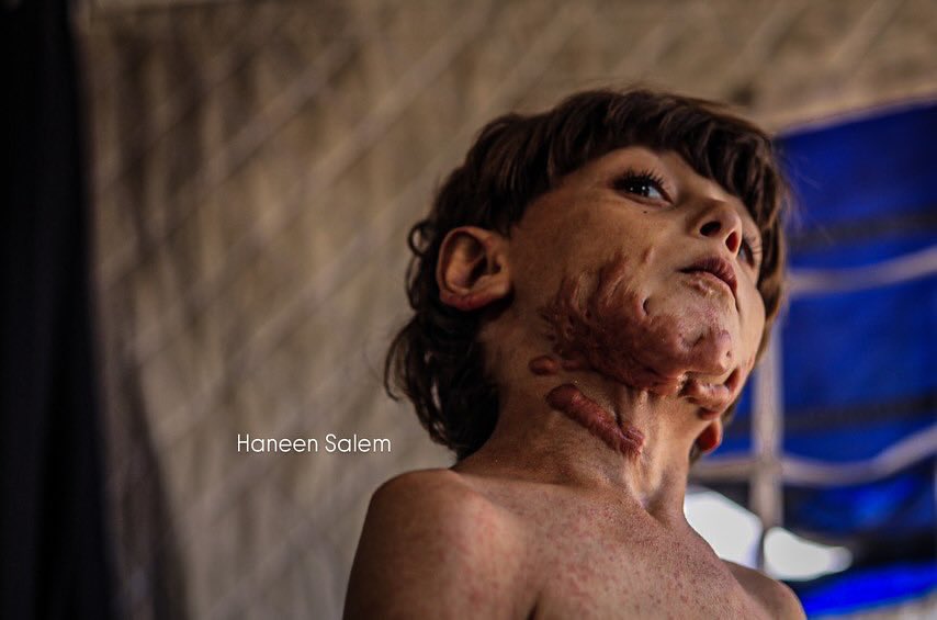 Child survivor Mohammed Ma’rouf bears scars one year later
