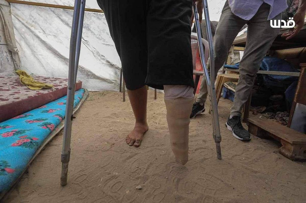 Physiotherapist Provides Prosthetics to Amputees in Gaza