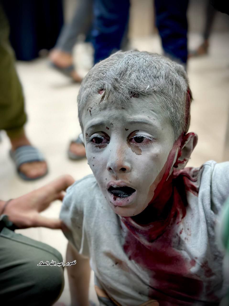 Palestinian Child Injured in Israeli Airstrike on Deir al-Balah