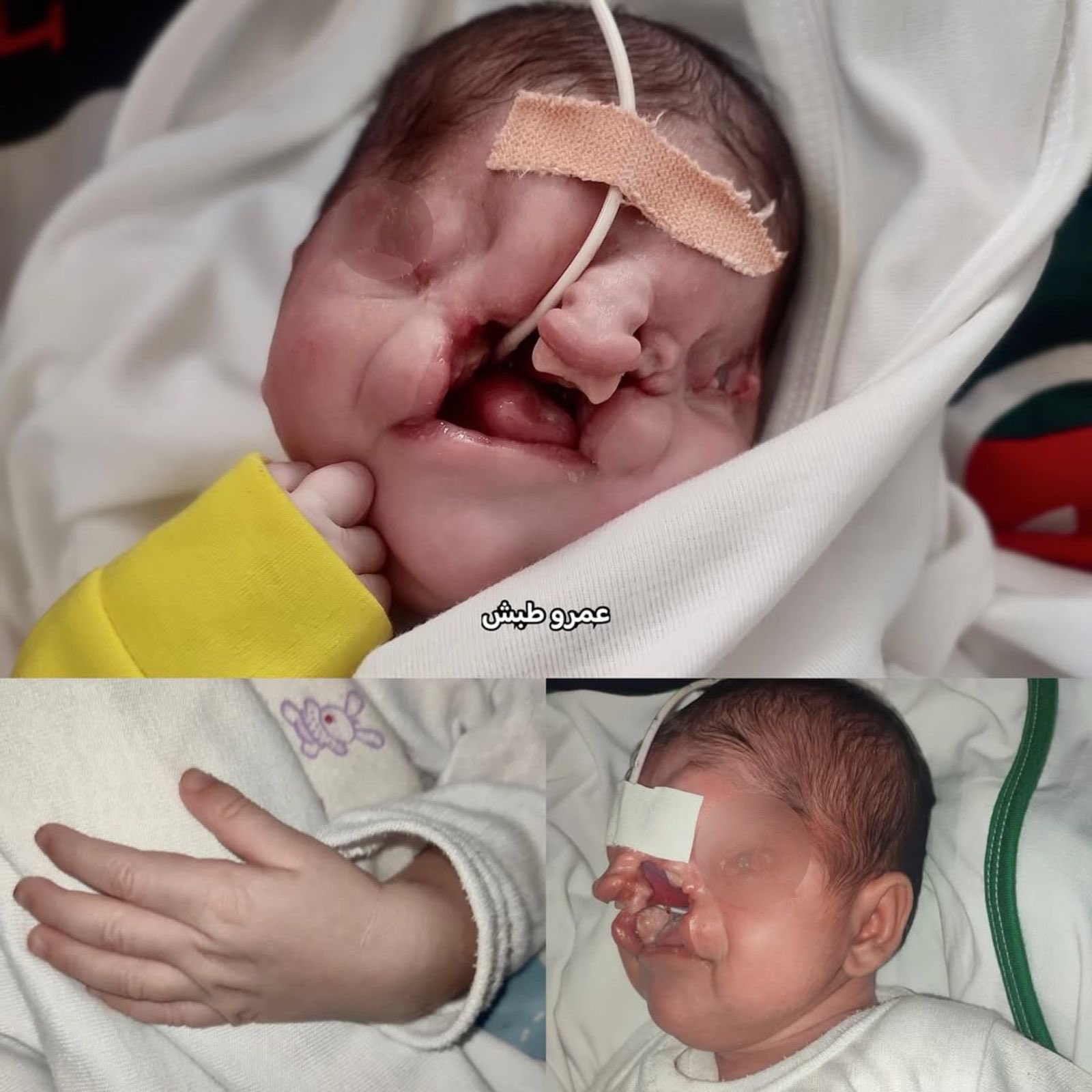 Newborn Baby Born with Facial Deformities from War Exposure