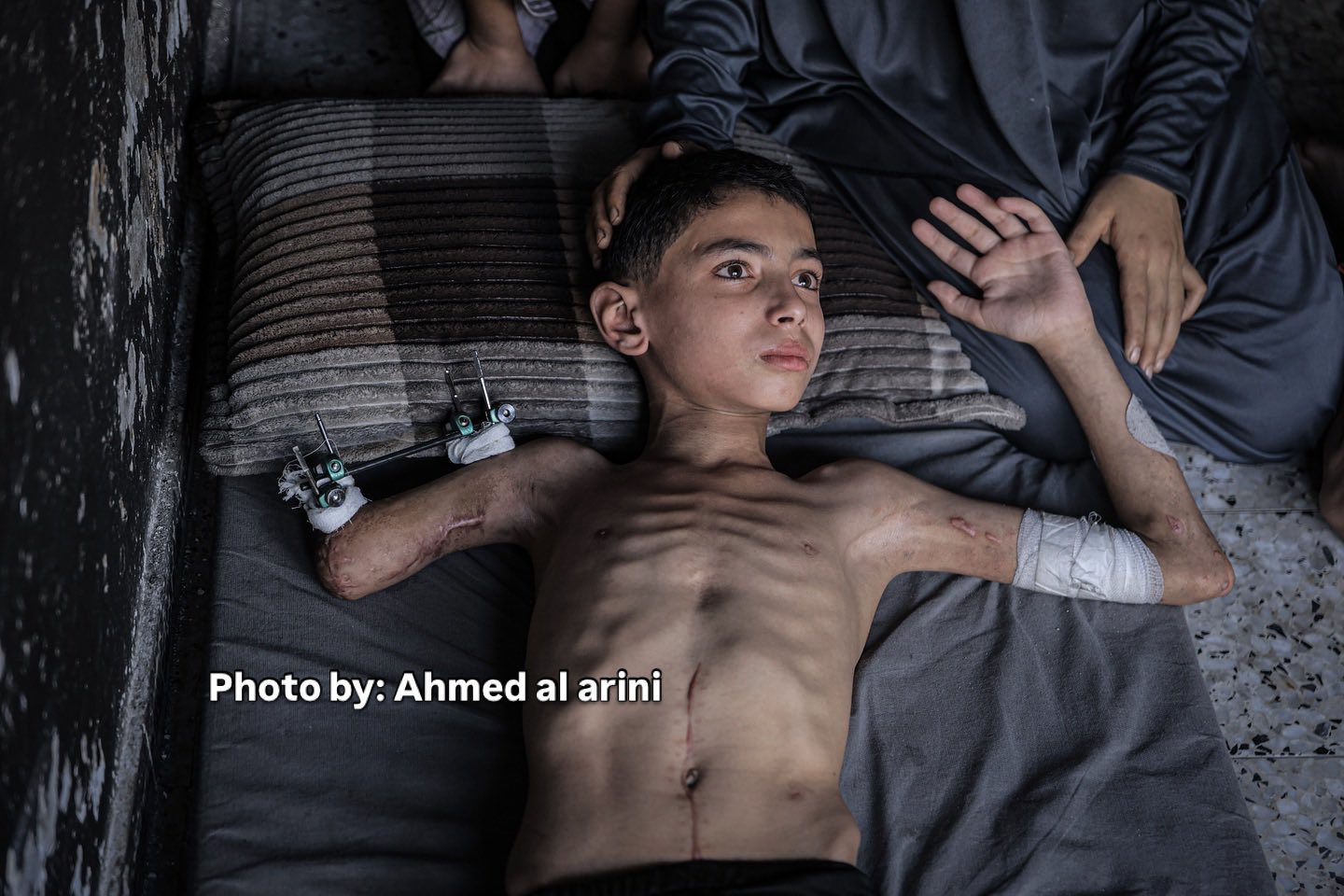 11-Year-Old Samir Lost Limbs in Israeli Strike, Needs Evacuation