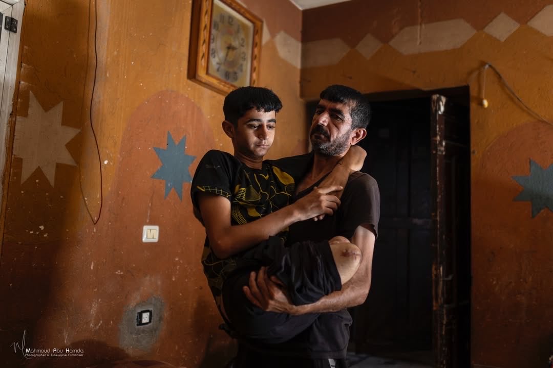 Gaza teen loses both legs, testicles, liver, and spleen in injury