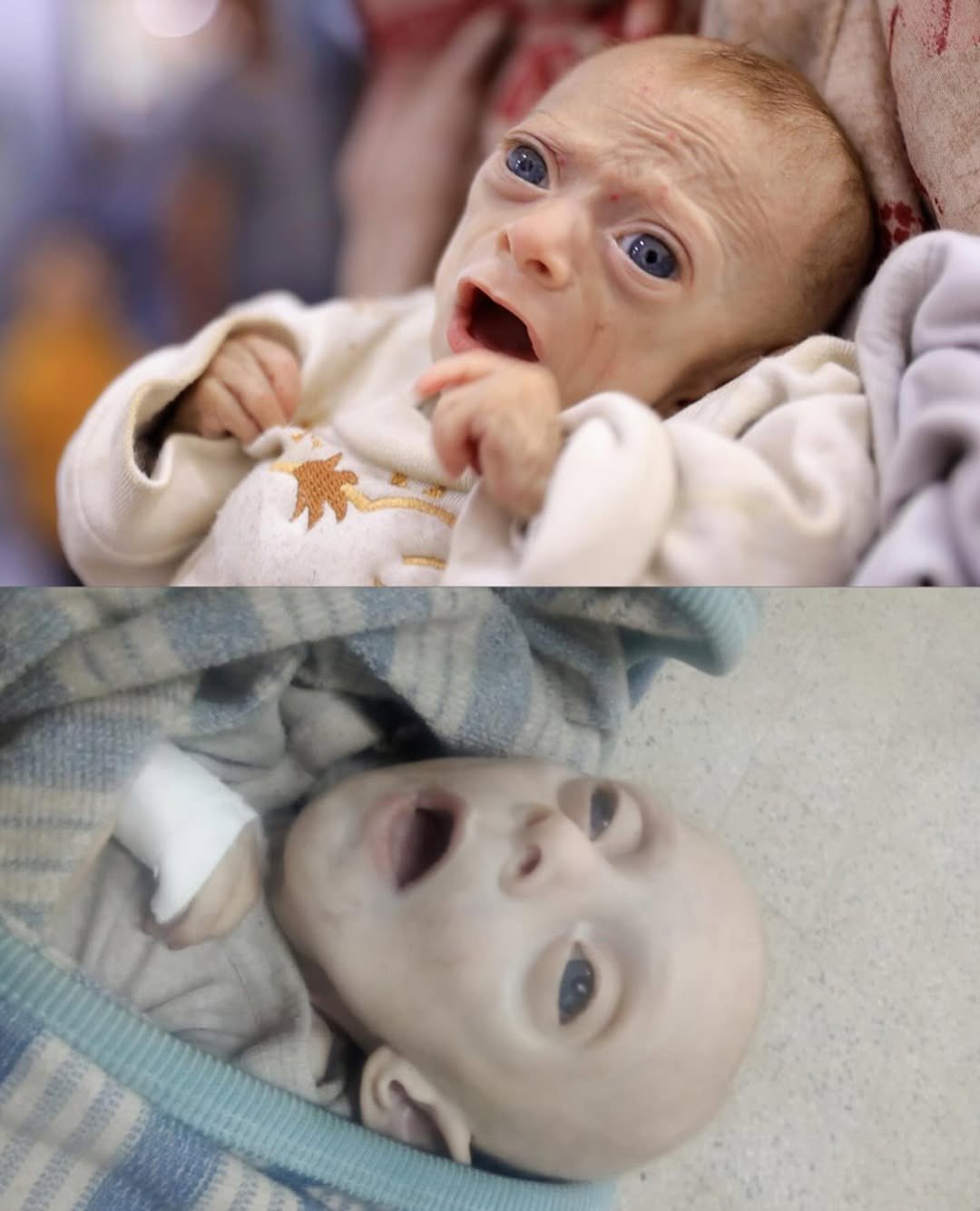 Child Death from Hunger in Gaza Amid Medical Crisis