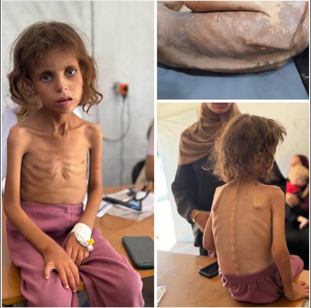 Five-Year-Old Mai Abu Arar Struggles with Severe Malnutrition and Anemia