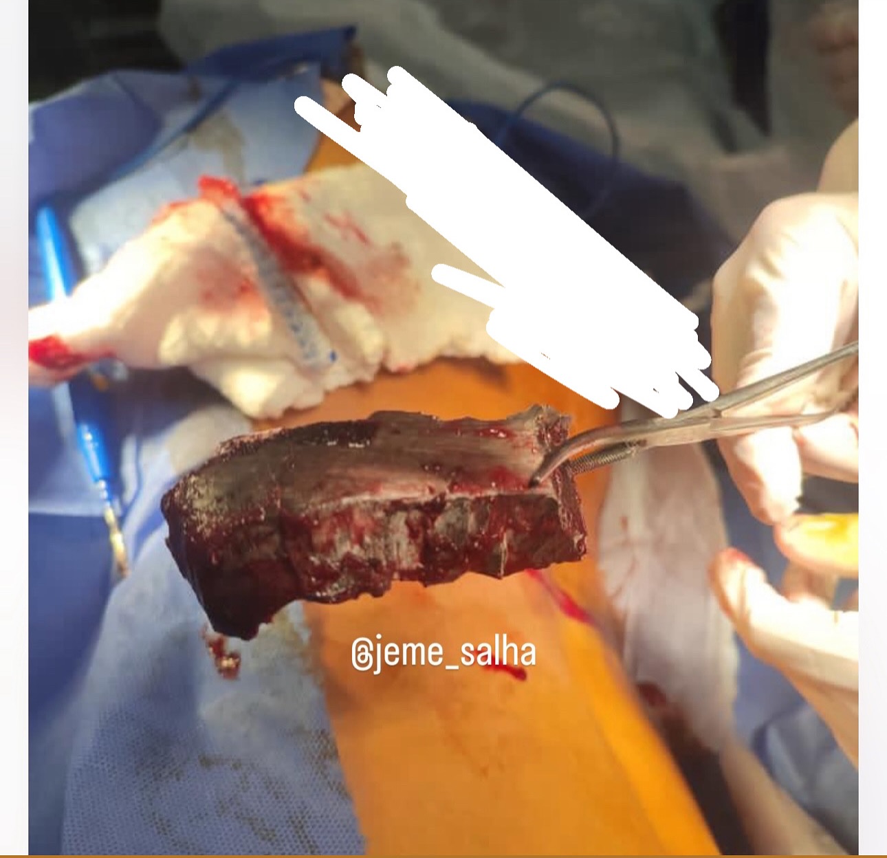 Large Shrapnel Removed from Young Man’s Back in Gaza