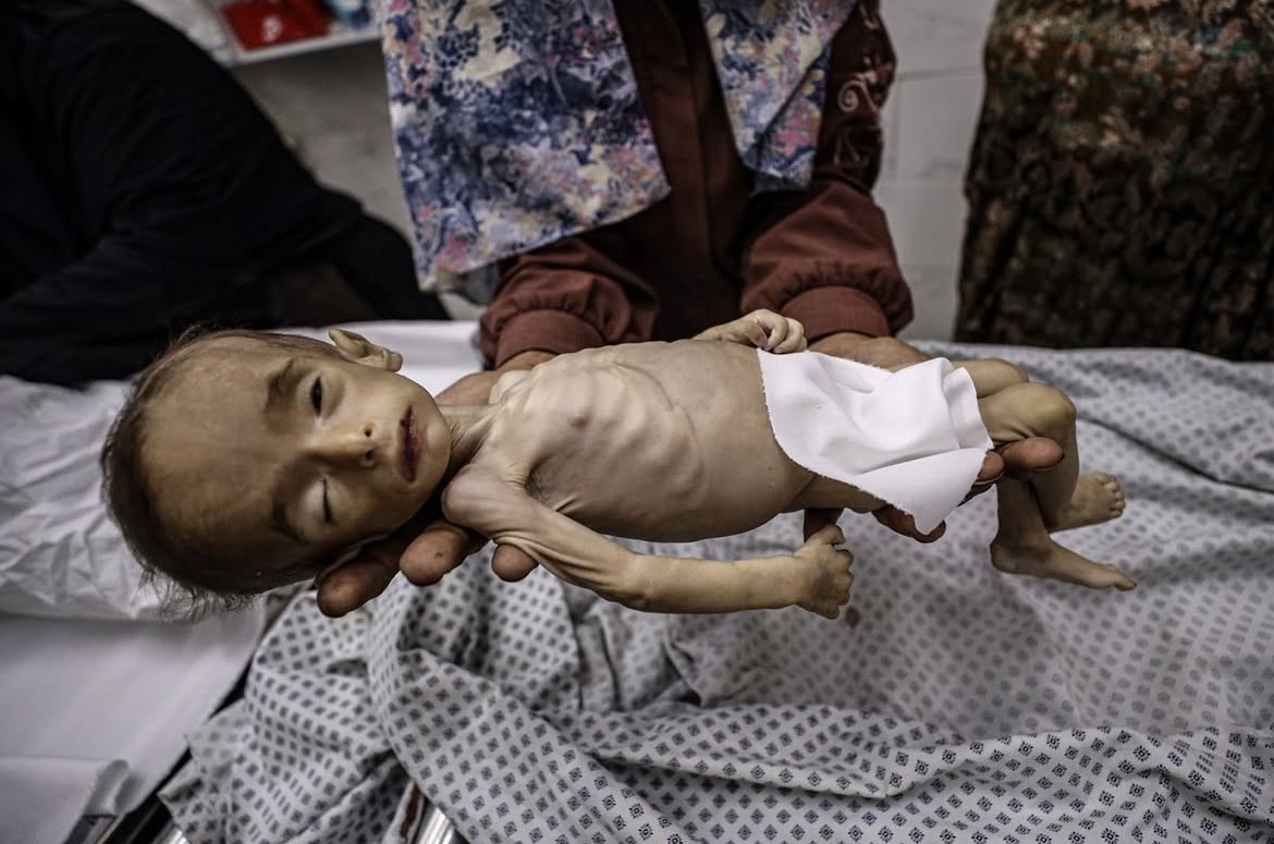 Arab-Israeli conflict: infant starvation amid ongoing siege