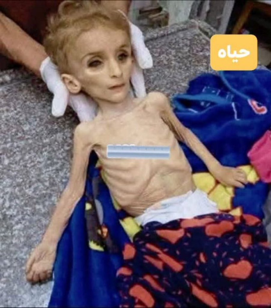 Hunger Deaths Crisis: 332 Total Including 124 Children