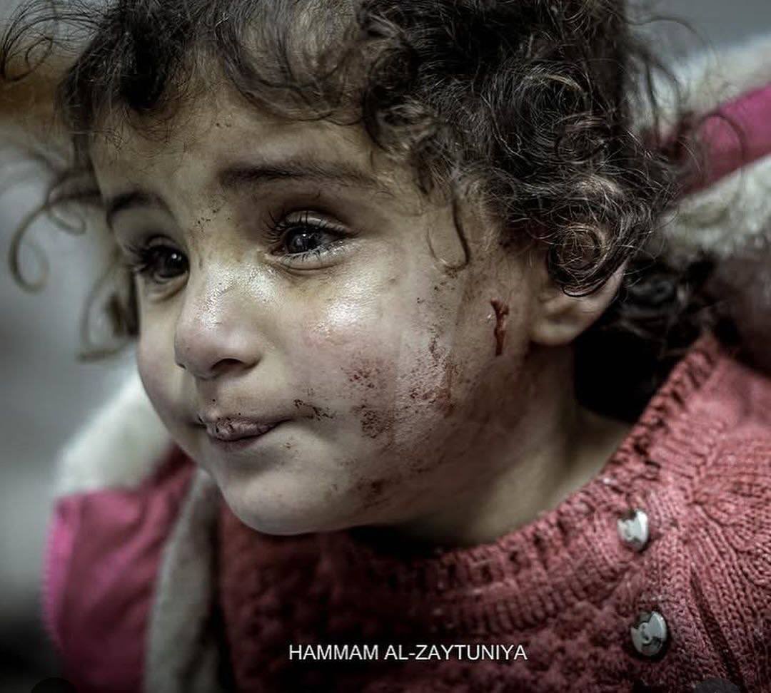 Blind 3-Year-Old Child Injured in Gaza Airstrike