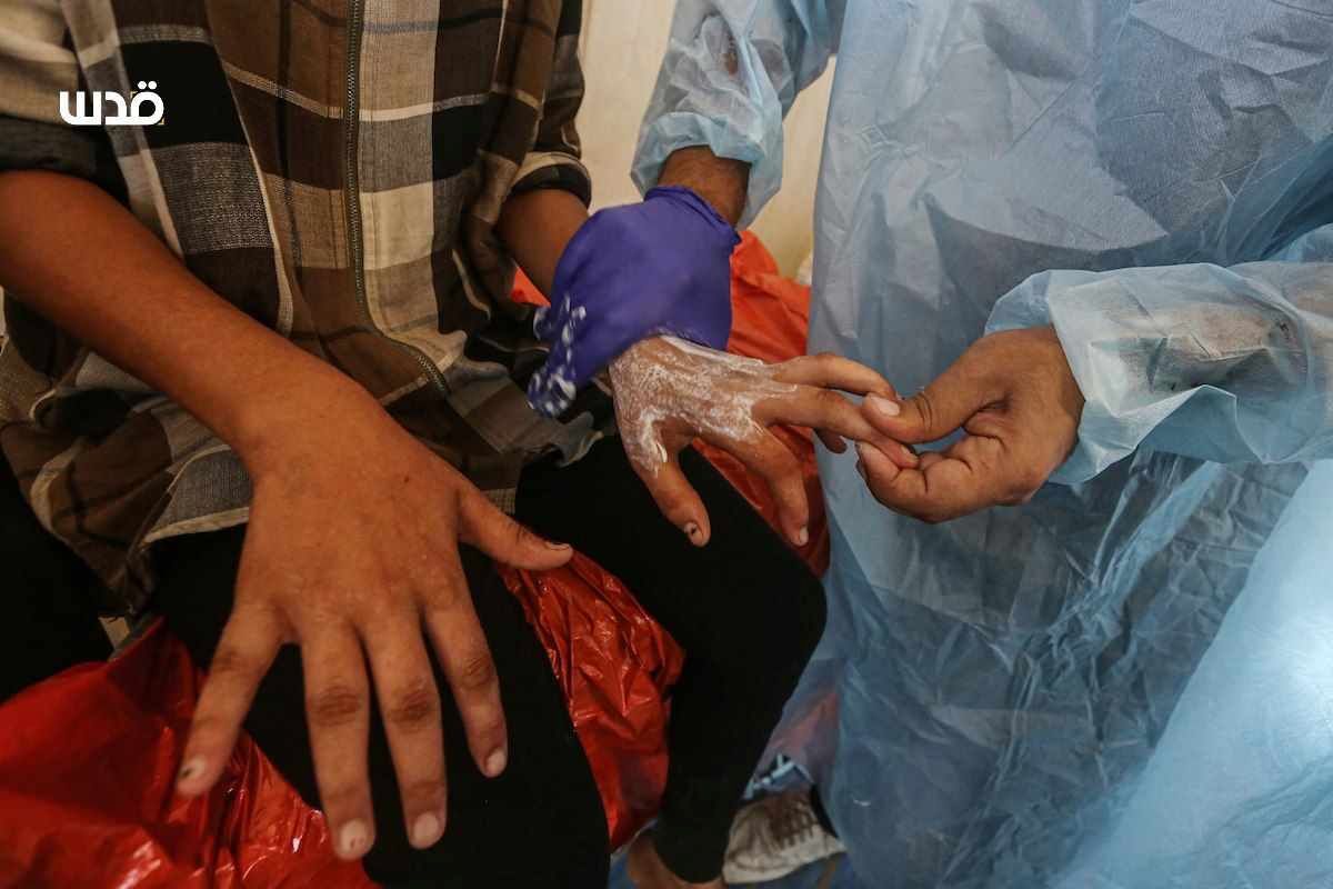 Skin Diseases Outbreak Among Displaced Palestinians in Camps
