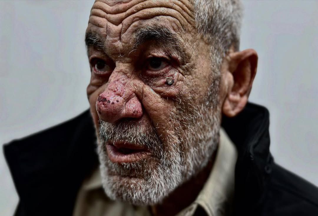 Palestinian man shows torture marks after release from Israeli detention