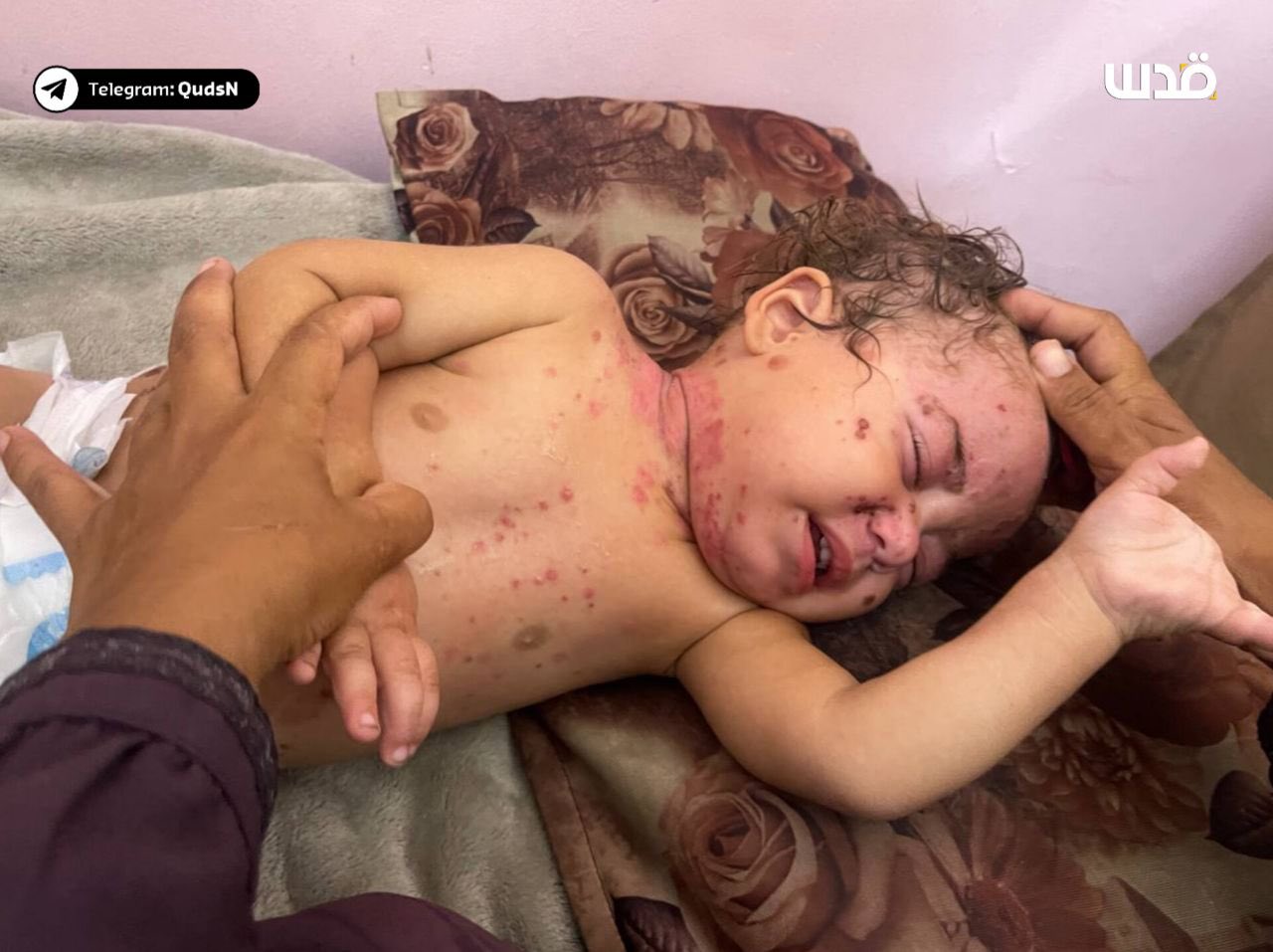 Child Suffering Skin Rash from Lack of Clean Water in Gaza