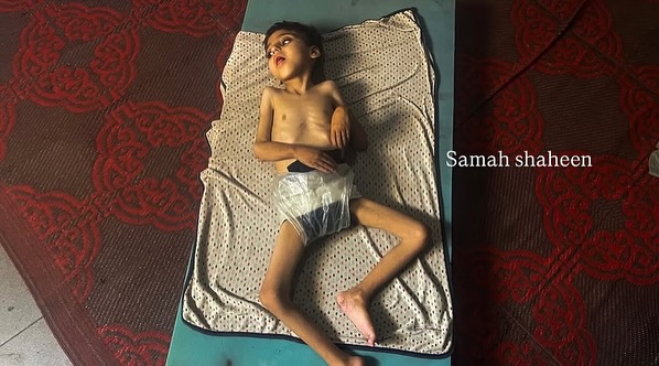 Children in Gaza Face Severe Hunger and Malnutrition Crisis