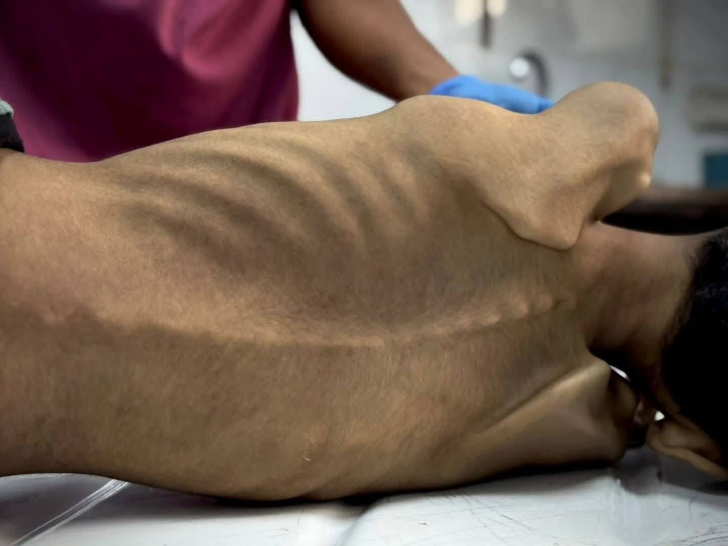 10-Year-Old Girl Dies from Hunger and Malnutrition in Gaza Hospital