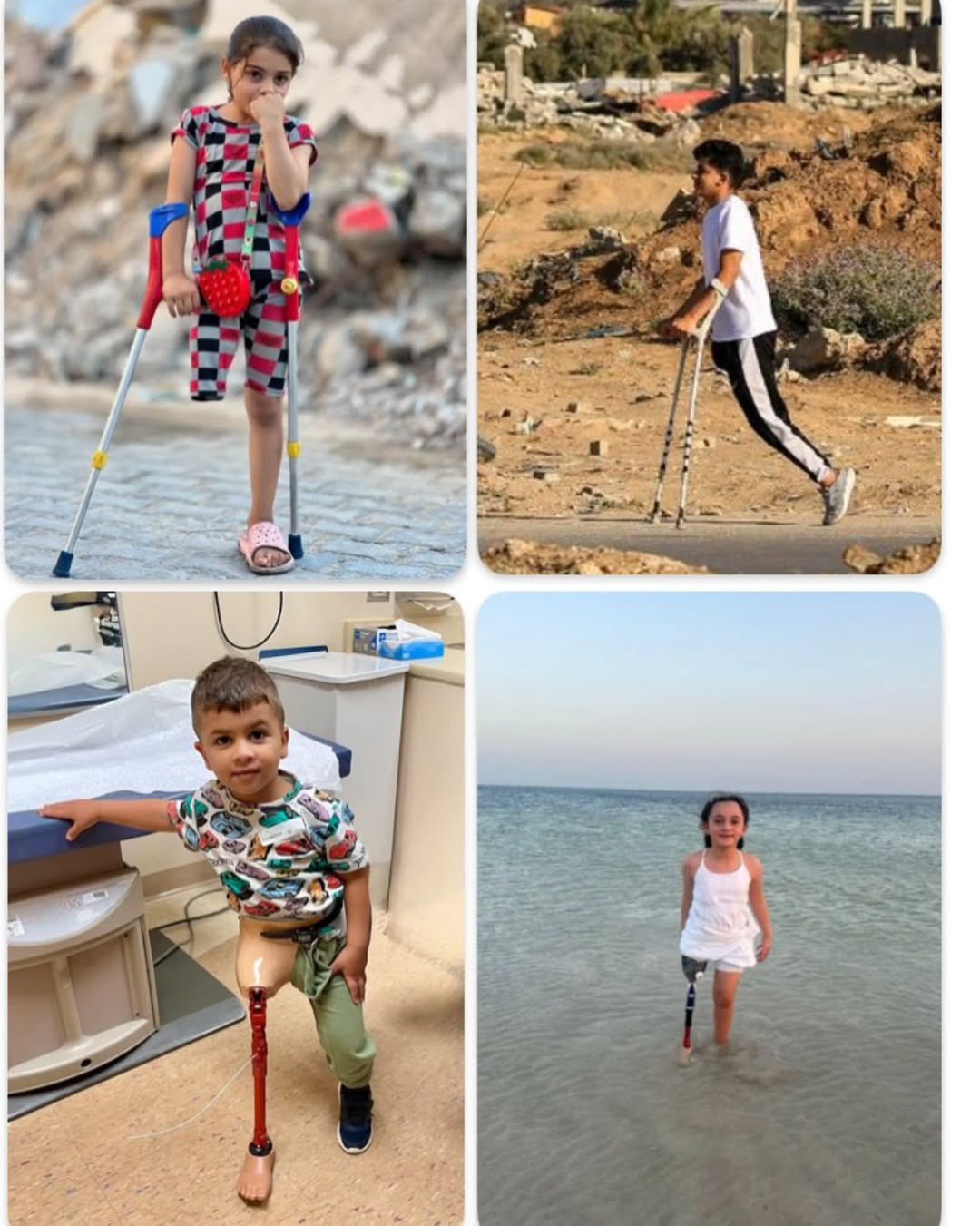Gaza Faces World’s Highest Limb Loss Crisis Among Civilians