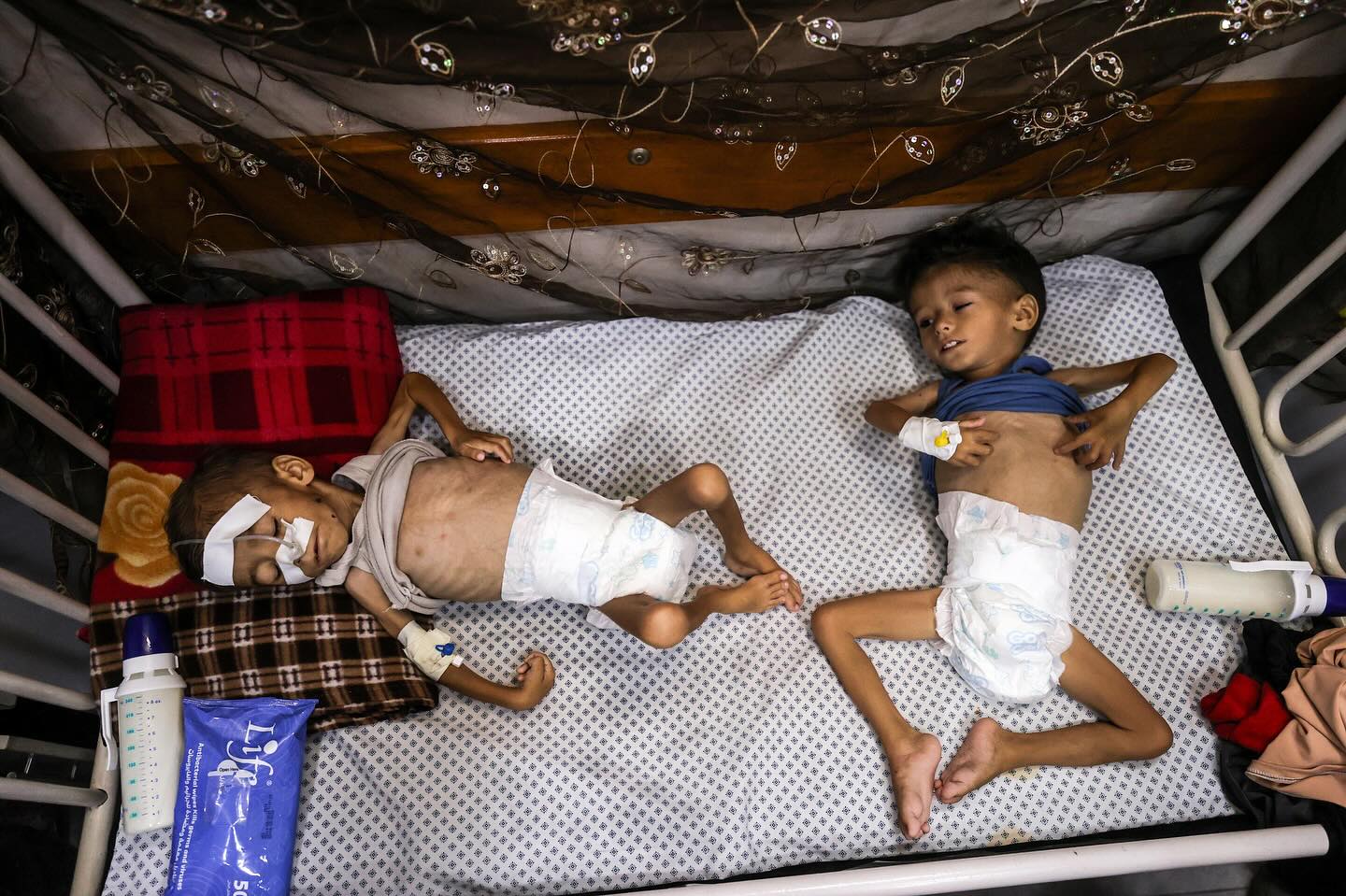 Young Brothers Battle Critical Malnutrition at Hospital