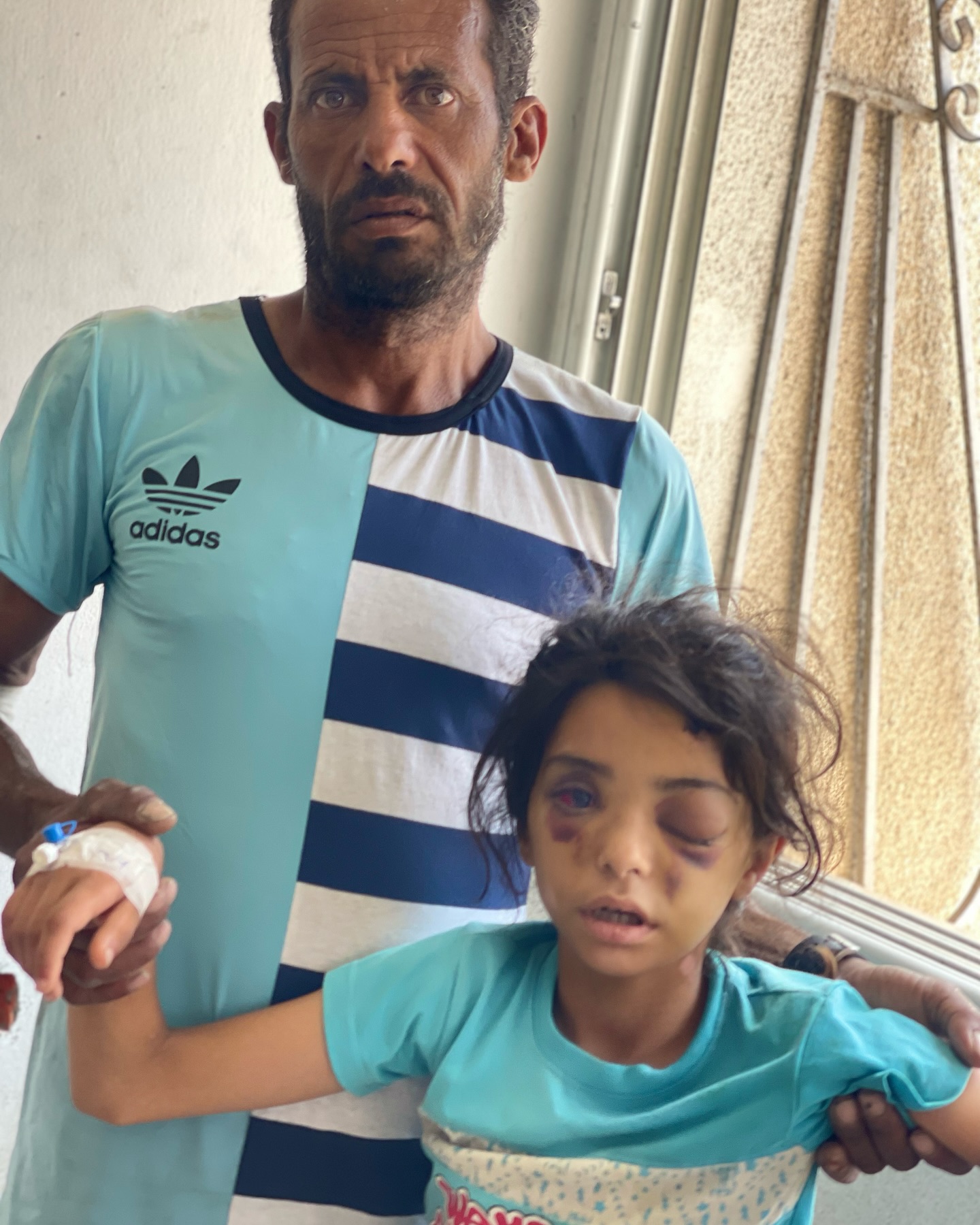 Nine-year-old girl critically injured in airstrike, unable to speak