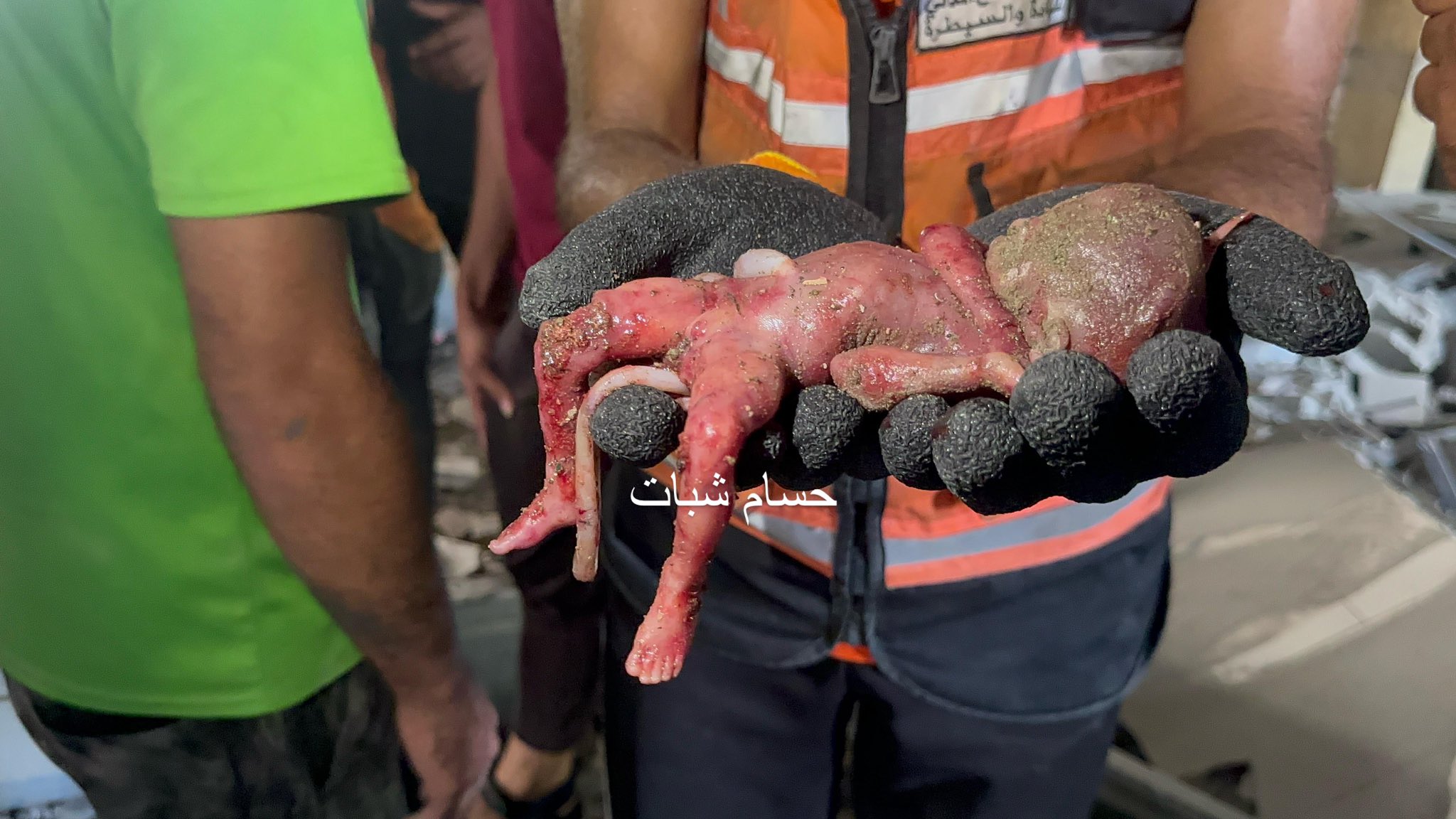 Fetus killed by occupation airstrikes before birth