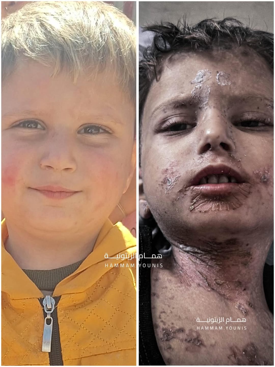 Child Amir Al-Mughanni Suffers from Severe Malnutrition and Famine