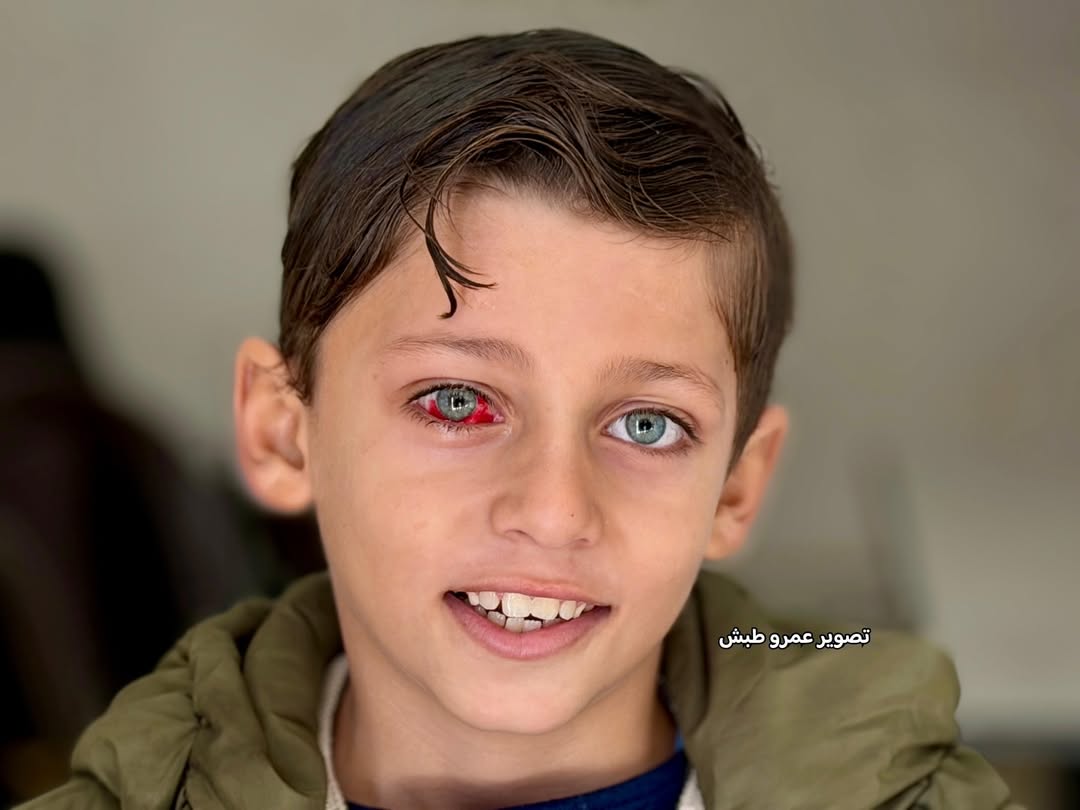Child at Risk of Blindness Urgently Needs Medical Treatment