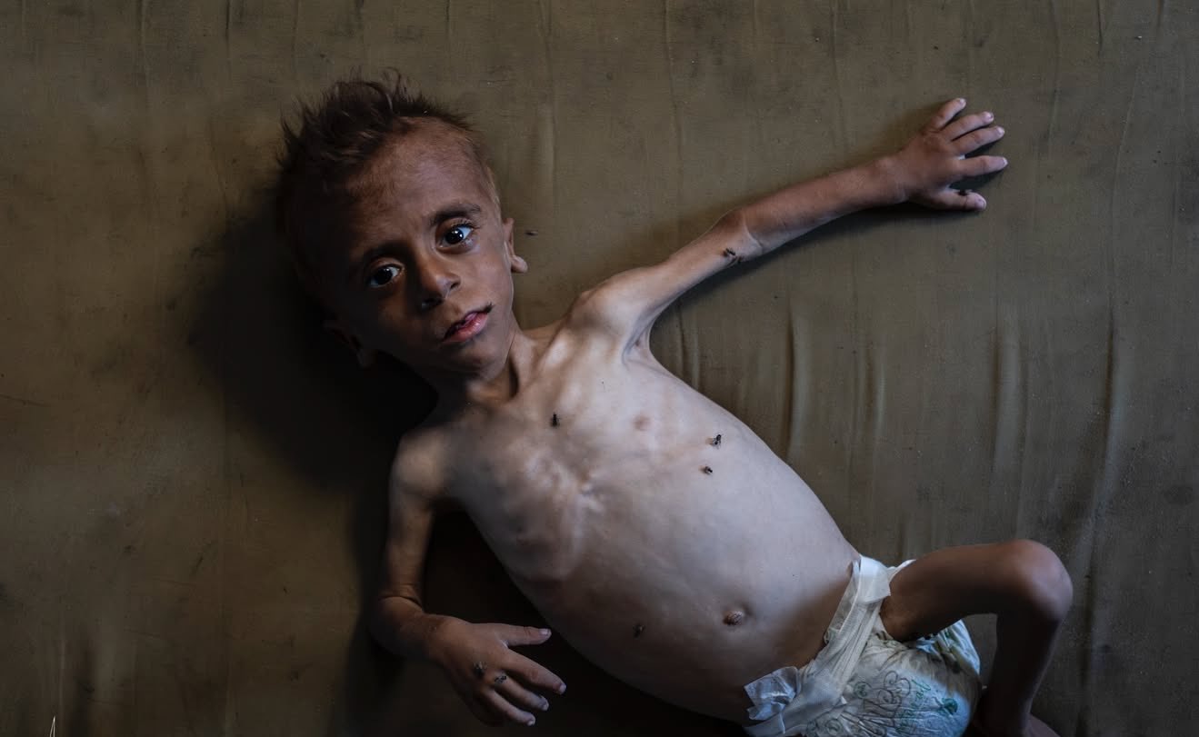 Gaza Faces Severe Famine: Over 100 Deaths from Malnutrition