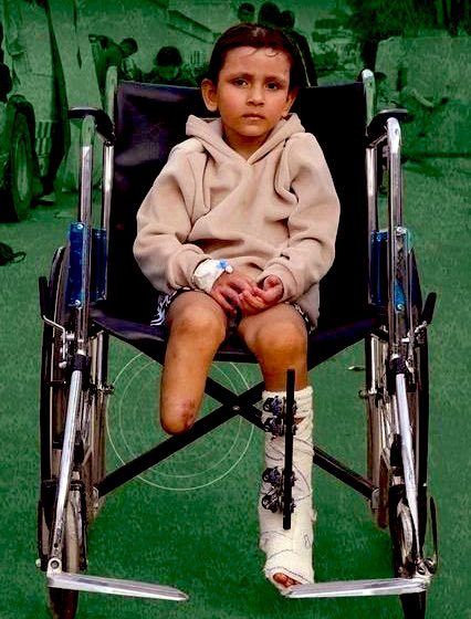 Gaza child amputees: largest documented population globally