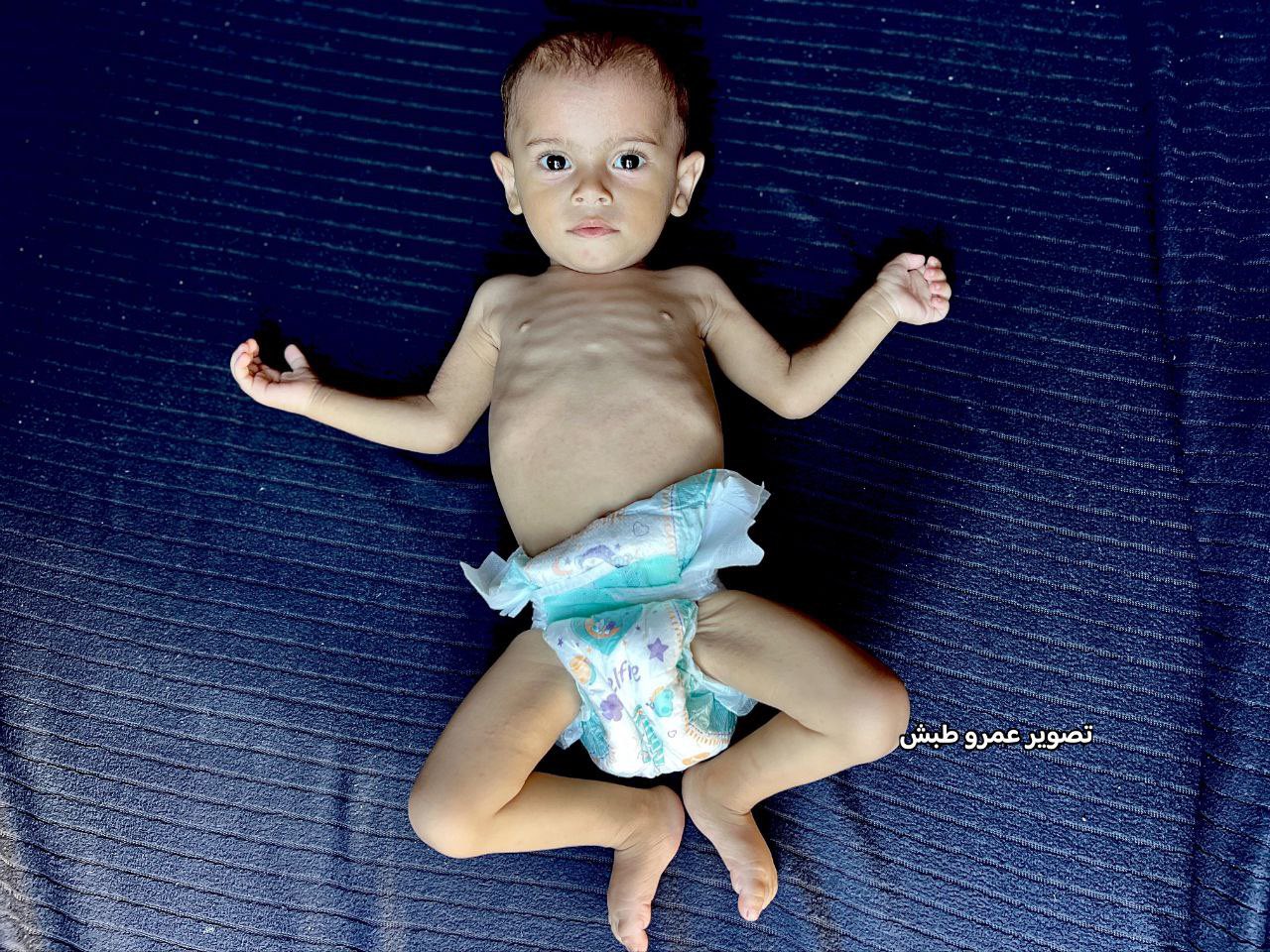 Child Suffering from Malnutrition After Father’s Death