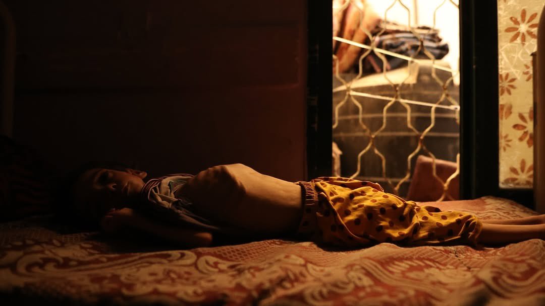 Severe Malnutrition Crisis: Five-Year-Old Razan Weighs Under Five Kilograms