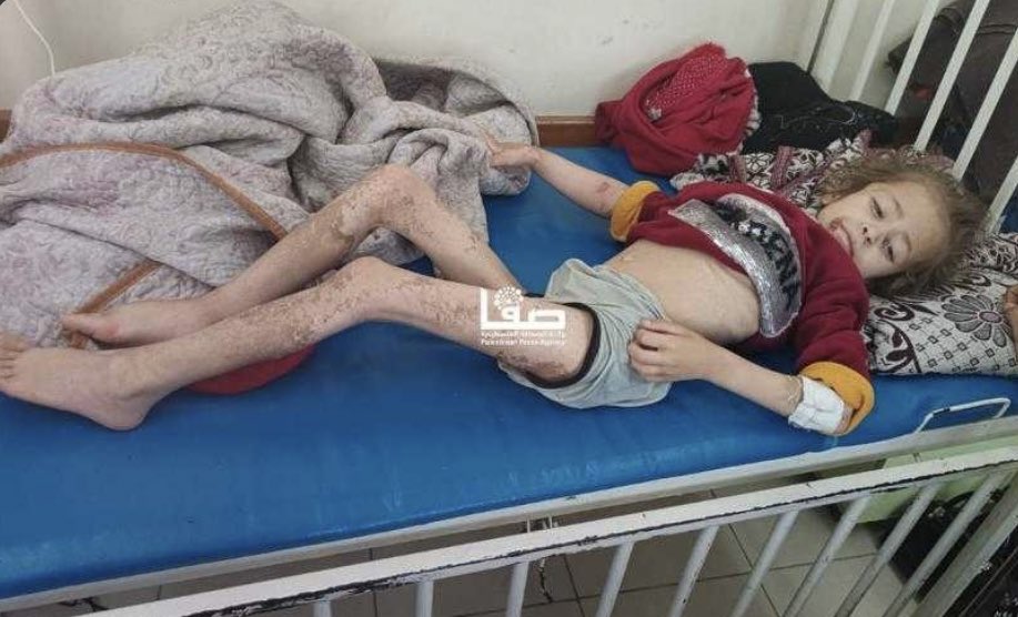 Jana Ayyad Dying from Malnutrition in Northern Gaza