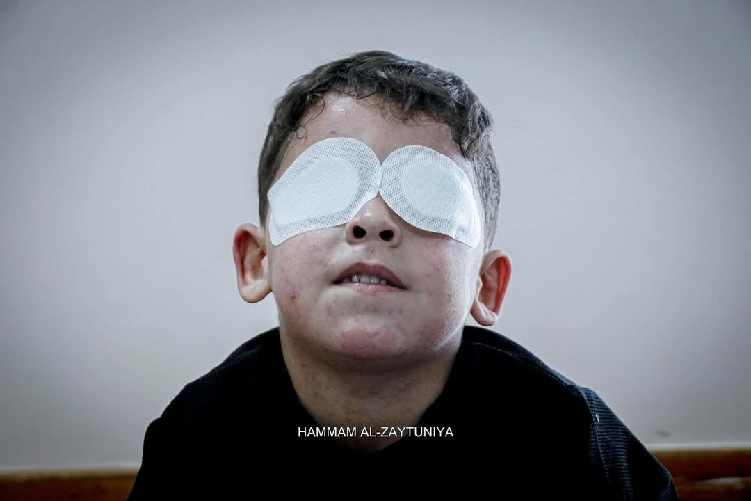 Child from Gaza loses sight in bombing, war extinguishes hope
