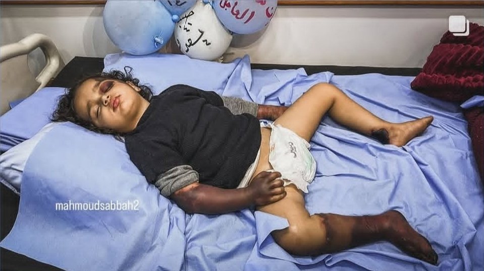 Occupation obstructs medical treatment for injured Palestinian girl Habiba