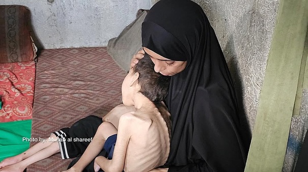 Two Brothers Face Severe Malnutrition and Cerebral Palsy Crisis