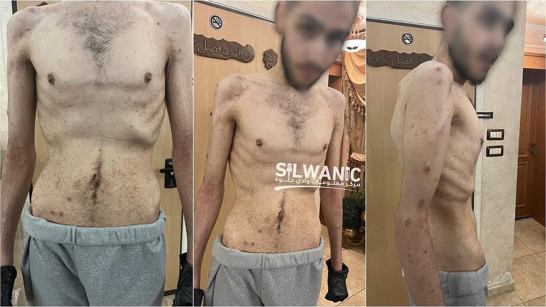 Palestinian Prisoner Health Conditions in Israeli Detention
