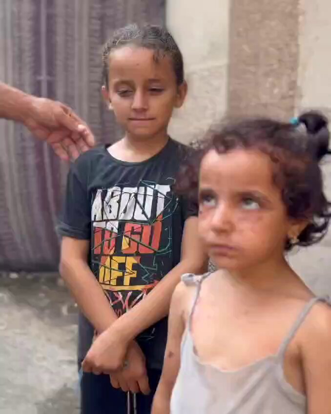 Child’s Face Disfigured by Disease from Pollution and Medicine Shortage