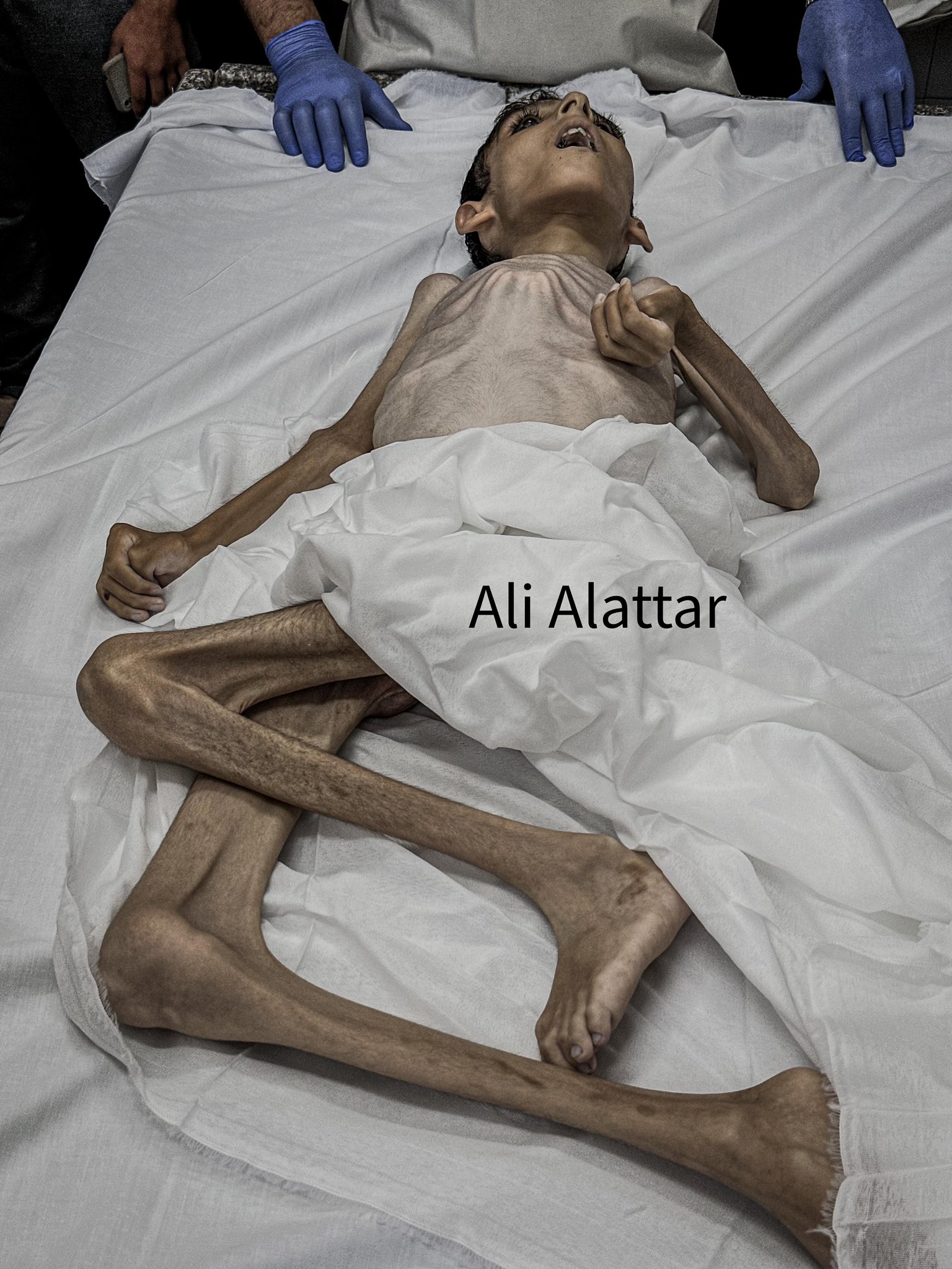 13-Year-Old Gaza Boy Dies From Malnutrition