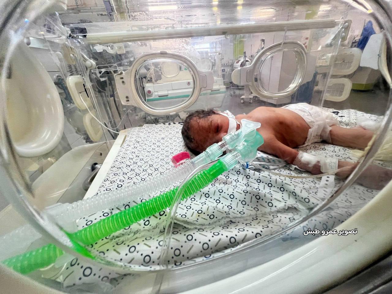 Premature infants face severe malnutrition due to milk supply cutoff